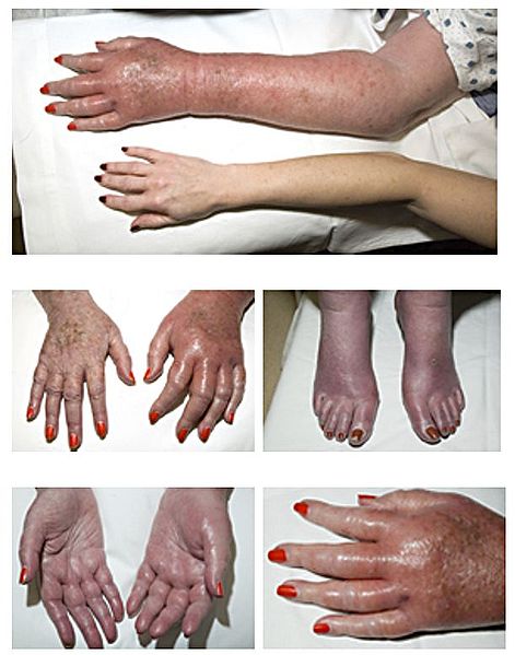 Erythromelalgia - different images