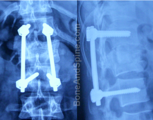 Postoperative picture of burst fracture L1 vertebra fixed by pedicle screw assembly