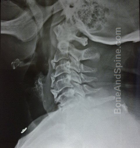 cervical osteophytes