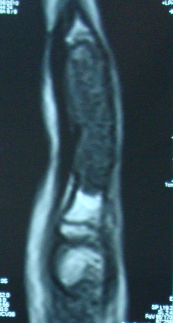 MRI of Enchondroma