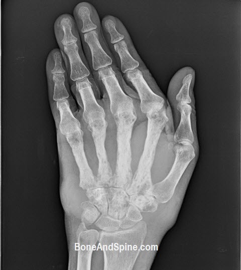 fungal osteomyelitis