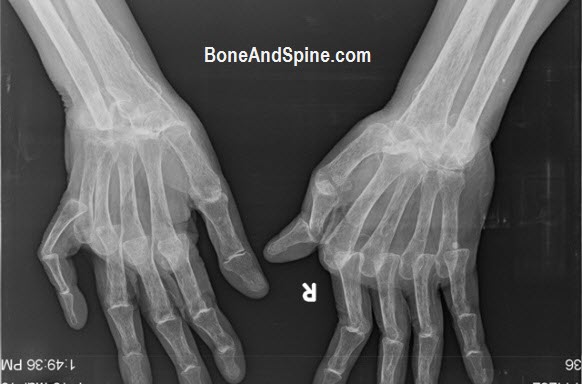 Bilateral Deformed Hands In Rheumatoid Arthritis