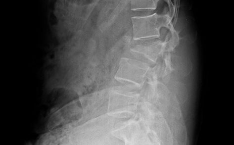 Cureus, Complex Compression Fracture in the Thoracolumbar Junction: A Case  Report