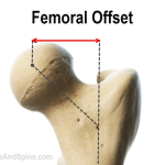 femoral offset