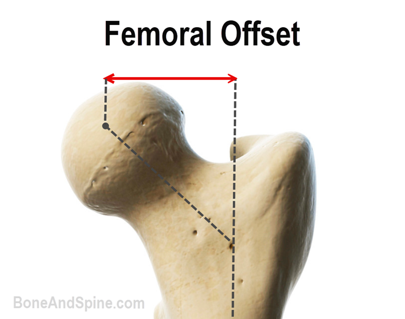 femoral offset
