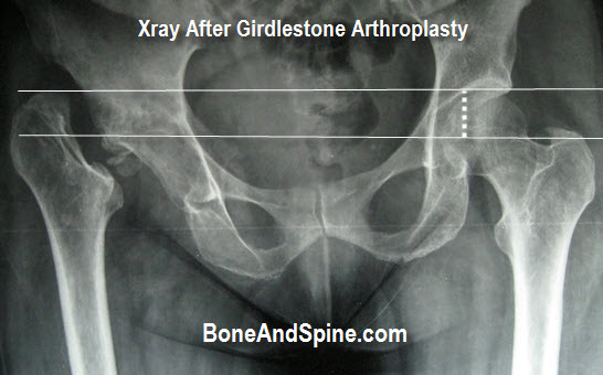 Xray of 48 years old man who had undergone Girdlestone Procedure for tuberculosis of the right hip. Note the difference in levels of tip of trochanter.
