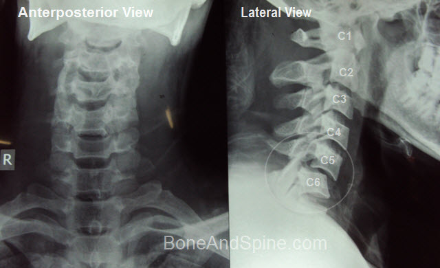 Cervical injury -c5-C6 dislocation of cervical vertebra