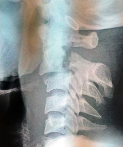 Thoracic Vertebrae - Physiopedia