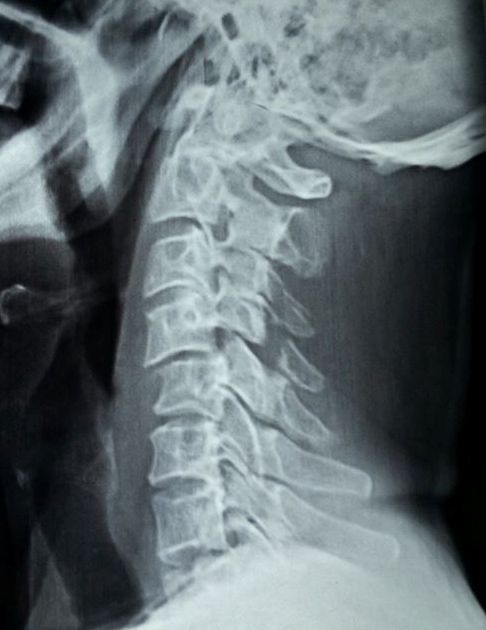 C4-5 Cervical injury xray