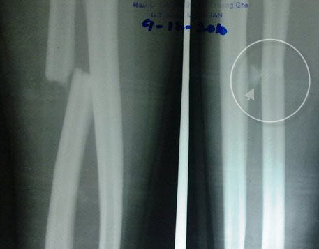 Forearm injuries xray showing fracture of upper third of radius