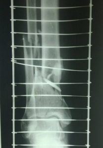 fracture-tibia-distal-third-comminuted-ap