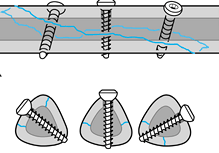 Interfragmentary screw fixation of fracture