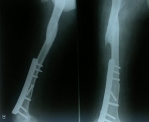 Xray of patient with fracture shaft femur in poliotic limb