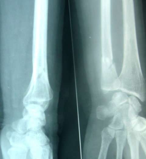 fracture ulna distal end