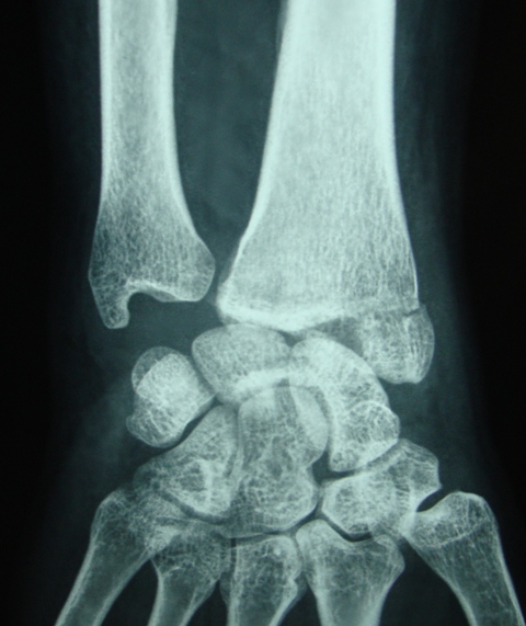 Fracture of Radial Styloid