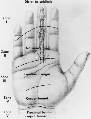 Tendon Zones In Flexor Aspect of Hand