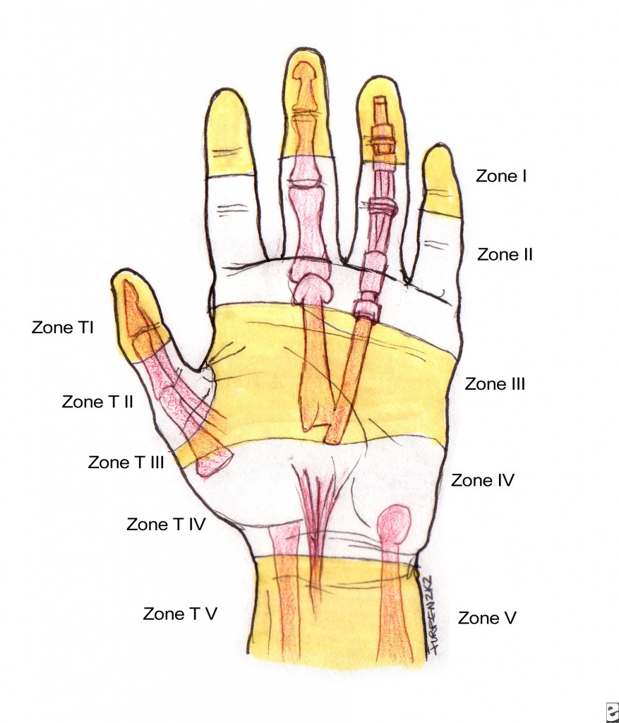 Tendon Zones of Flexor Aspect of Hand With Thumb Zones