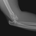 Lateral View Of Dislocation Of Elbow