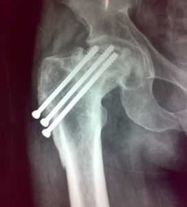 Femoral neck fractures - Collapsed Head Following AVN