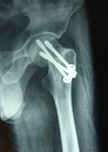 operated-fracture-neck-femur-lat