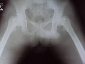 Xray After Reduction of Dislocated Hip Shows Congruent Reduction