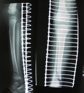 Distal tibia fracture in child following spoke wheel injury