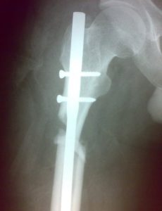 Poor fixation of subtrochanteric fracture