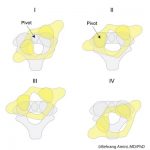 Classification of Atlantoaxial Rotatory Subluxation
