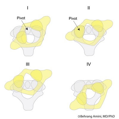 Fielding-atlantoaxial-rotatory-subluxation