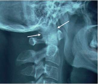 atlanto occipital joint xray