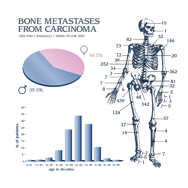 Spread of Bone Metastasis