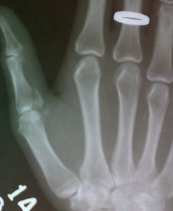 Thumb injuries - Intra-articular fracture of proximal phalanx of thumb