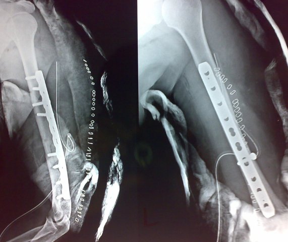 Operated Fracture humerus