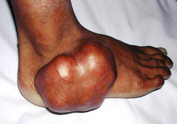 A clinical photograph of foot tumor
