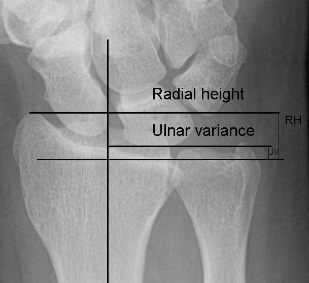 Ulnar Variance - Normal Values, Measurement and Abnormalities | Bone ...