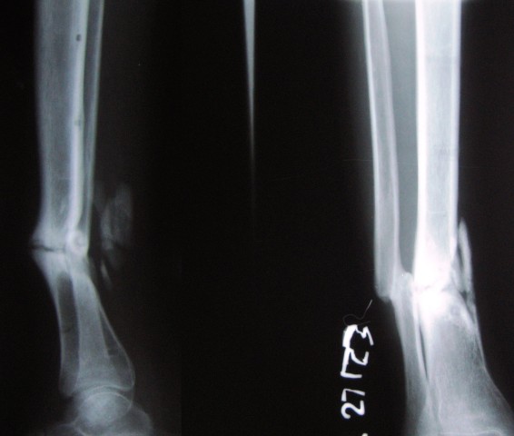 X-ray of fractre Tibia and Fibula Fibula malunited and tibia ununited