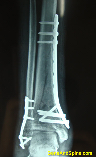 Distal Tibia Distal Fibula Treated With Open Reduction and Internal Fixation