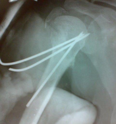 Fracture Upper End Humerus Fixed With Kwires