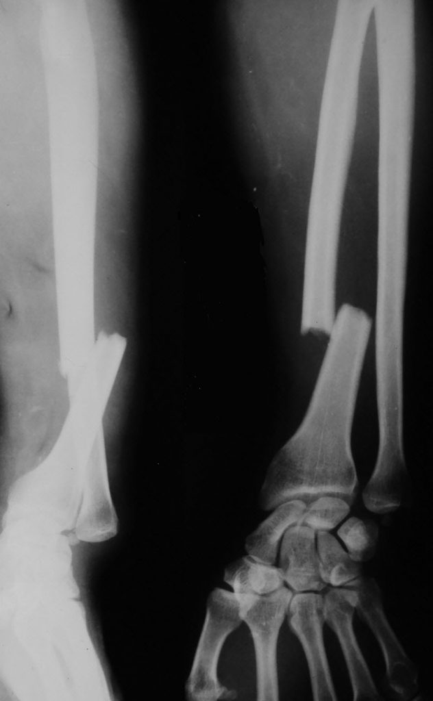 galeazzi-fracture dislocation