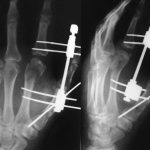Fracture Head Second Metacarpal With Fracture Shaft of First Metacarpal Fixred With Kwire and Finger Distractor