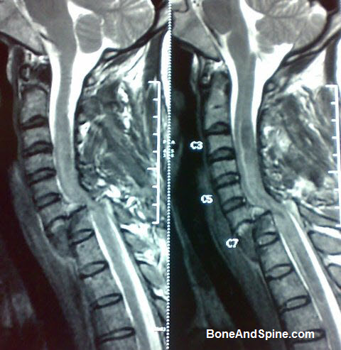 Dislocation of Cevical Spine C6 Over C7 with spinal cord injury