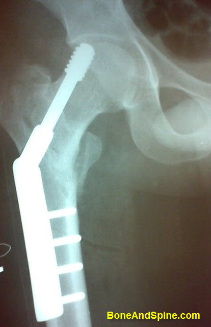 Malpositioned Lag Screw In Intertrochanteric fracture
