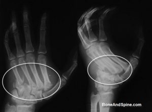 Fracture and dislocation of metacarpal bases