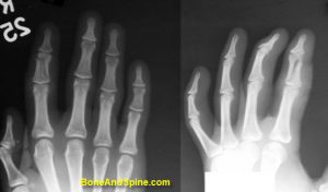 Fracture of Middle Phalanx