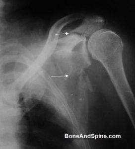 Fracture Of Scapula