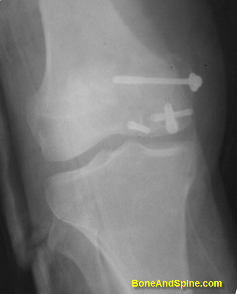 hoffa fracture fixed with cancellous screws and Herbert Screws