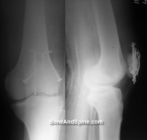 TBW In fracture patella