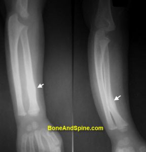 Fracture of Radius Bone In A Child