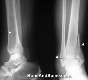 Bimalleolar Fracutre In Ankle