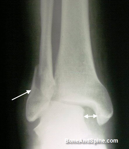 Fracture of Lateral Malleolus with Ankle Subluxation